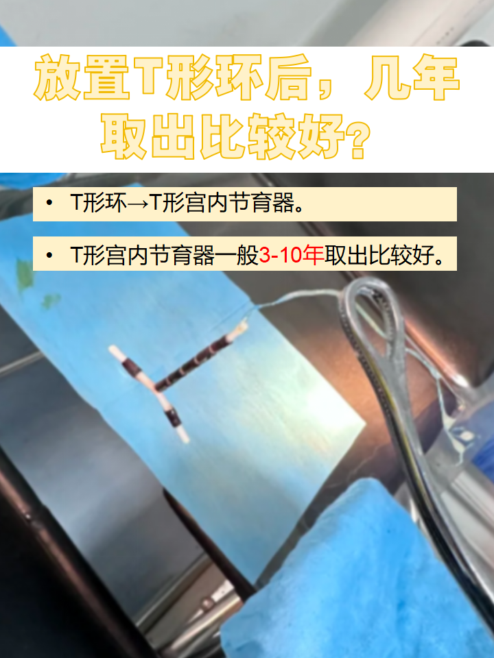t形环是指t形宫内节育器,是宫内节育器形态的一种
