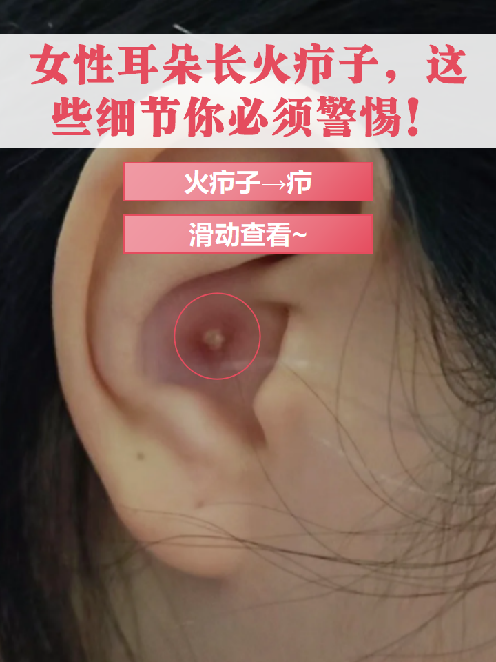 女性耳朵长火疖子,这些细节你必须警惕!