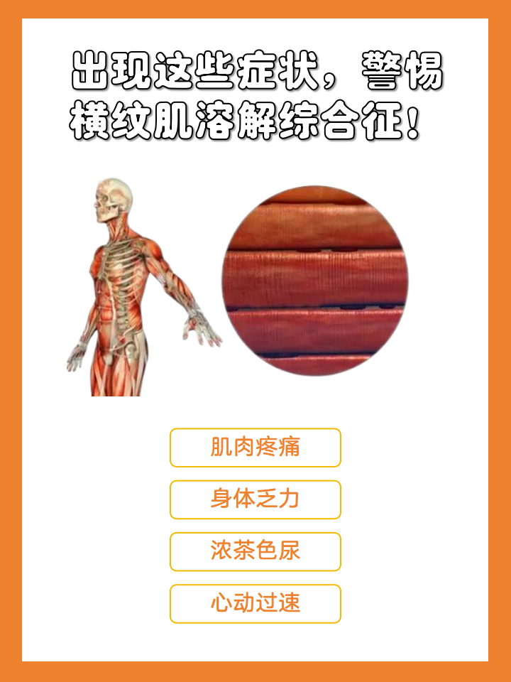 出现这些症状,警惕横纹肌溶解综合征!