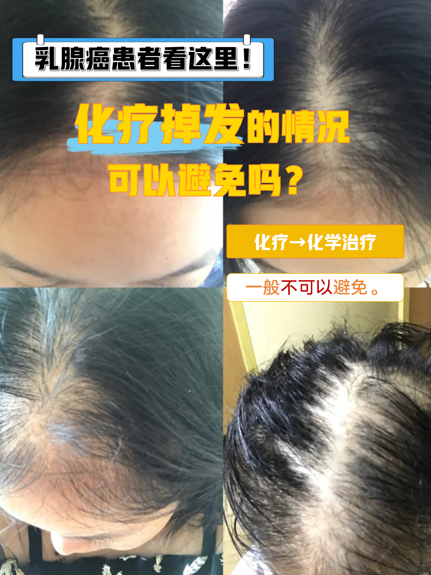 化疗为什么会掉头发?为什么在线 化疗为什么会掉头发?为什么在线