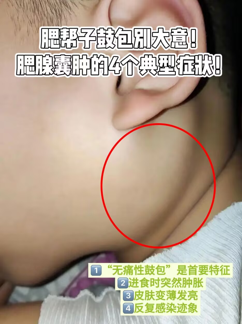 腮腺囊肿的4个典型症状!