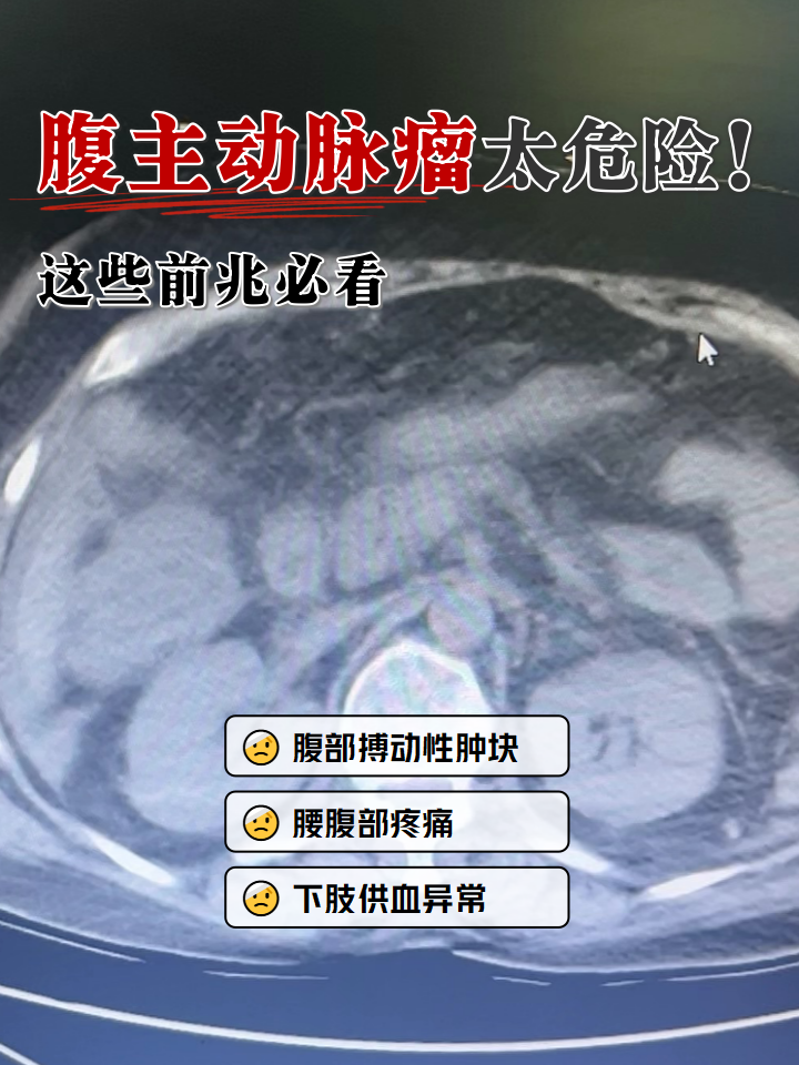 腹部突然出现钝痛,还摸到有节奏跳动的硬块,别简单当作