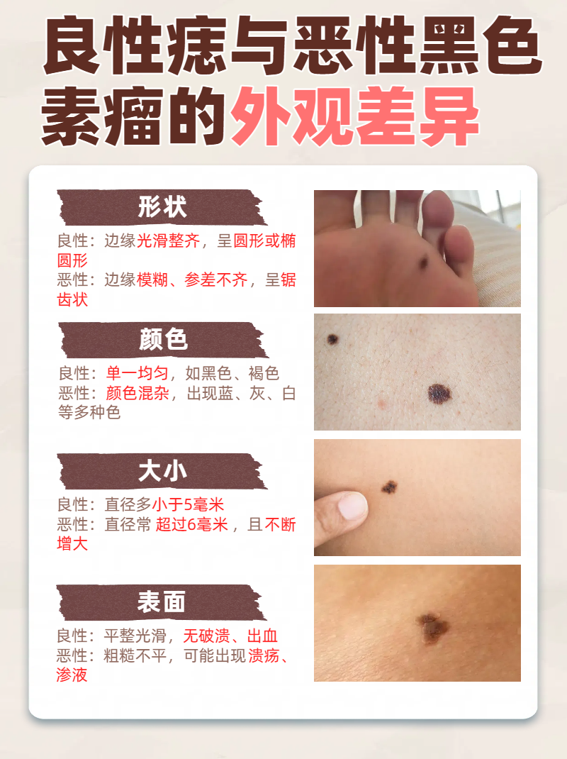 区分黑色素瘤良恶性的关键 形态变化判断 良性痣边缘规整