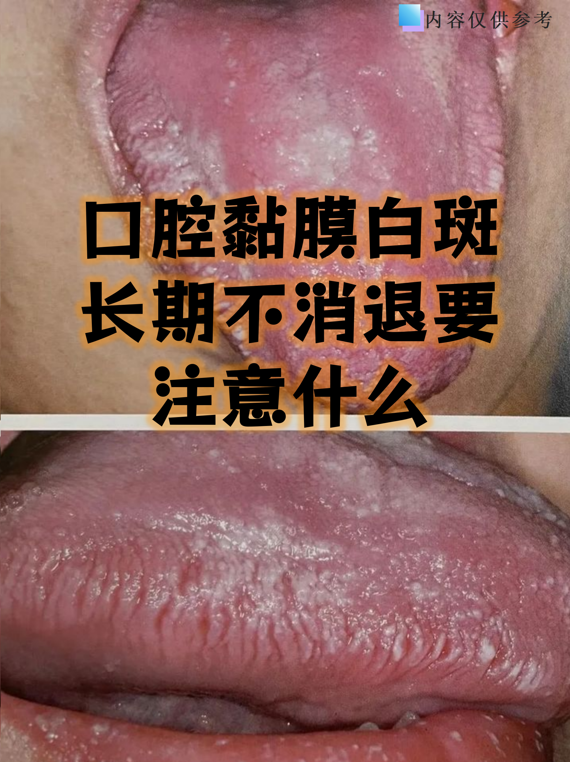 口腔黏膜白斑看似只是嘴里的小白点,但长期不消退可能暗藏健康隐患