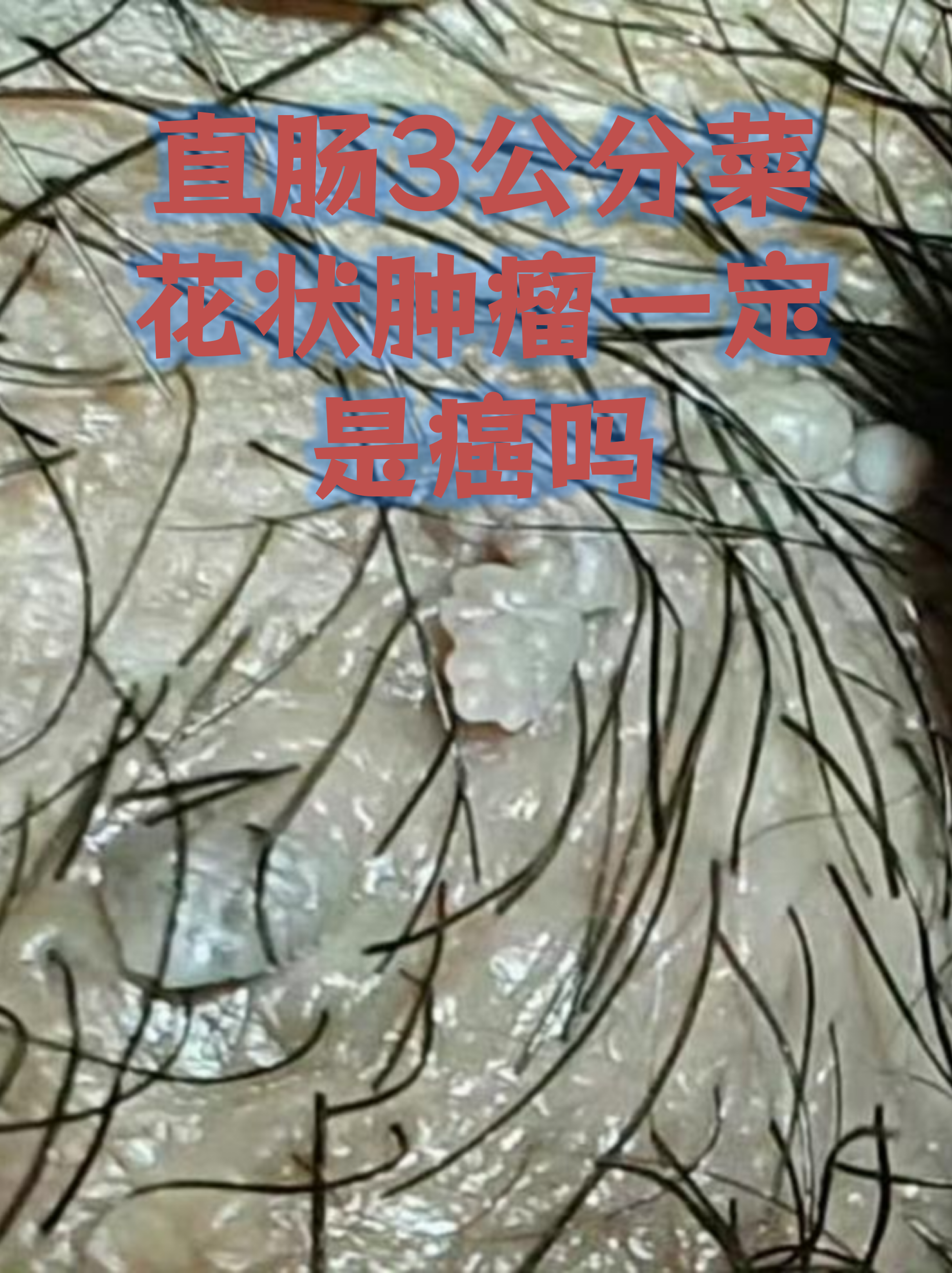 直肠3公分菜花状肿瘤一定是癌吗