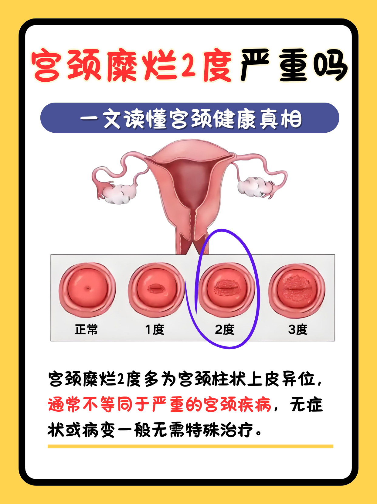 一文读懂宫颈健康真相 宫颈糜烂2度是女性常见的妇科问题之一,很多