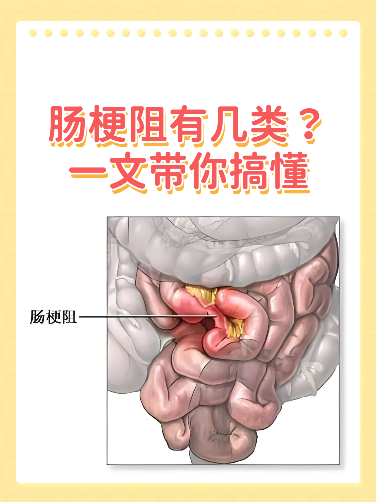 肠梗阻的10种表现