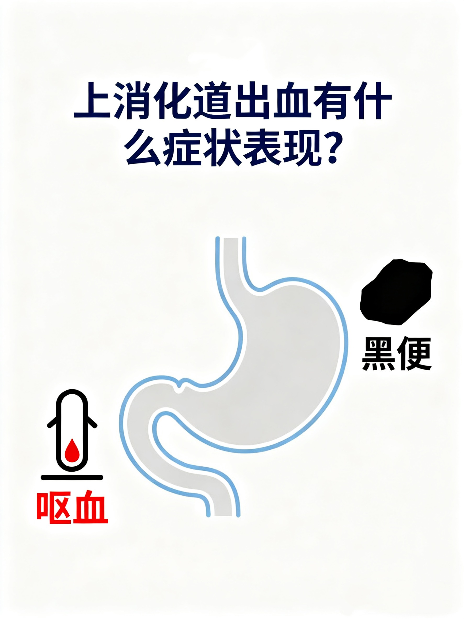 上消化道出血指食管胃十二指肠等部位出血症状因出血量和速度而异