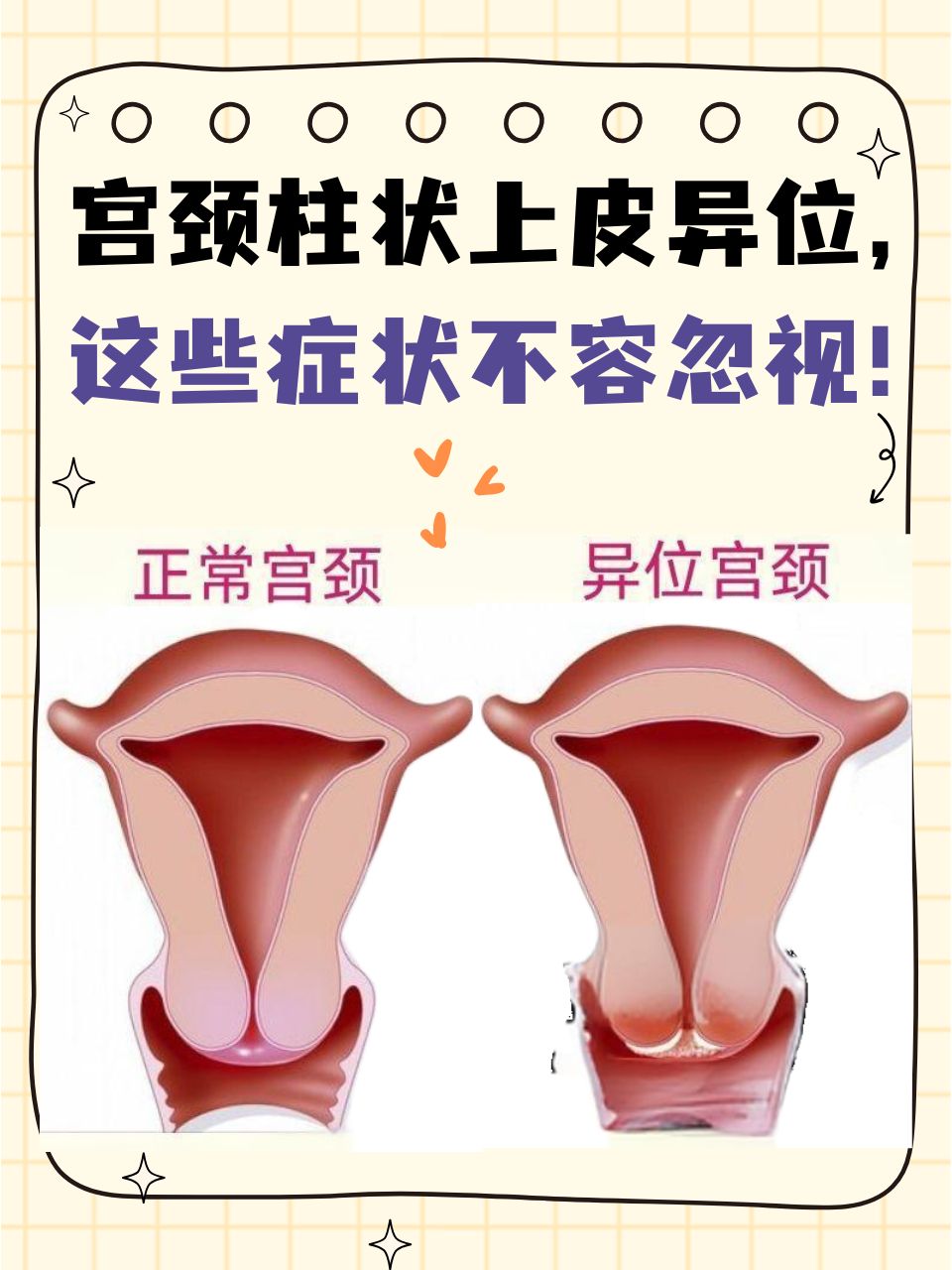 宫颈柱状上皮异位,这个听起来有些专业的名词,其实与很多女性的日常