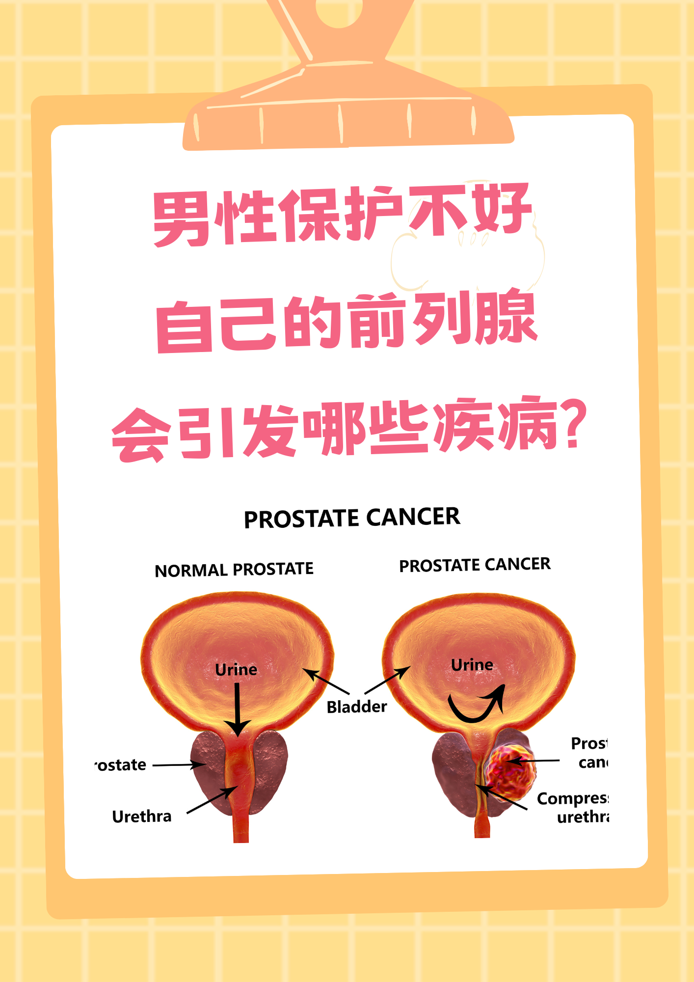 男性保护不好自己的前列腺,会引发哪些疾病 前列腺是男性健康的关键