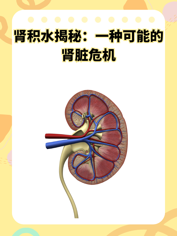 肾积水揭秘:一种可能的肾脏危机 肾积水又称肾盂积水,是指由于尿液在