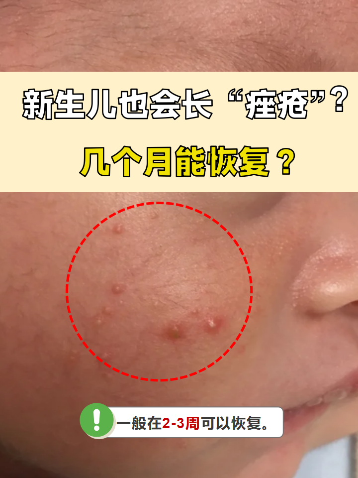 新生儿的皮肤通常是比较光滑,细腻的,但有的新生儿也可能长