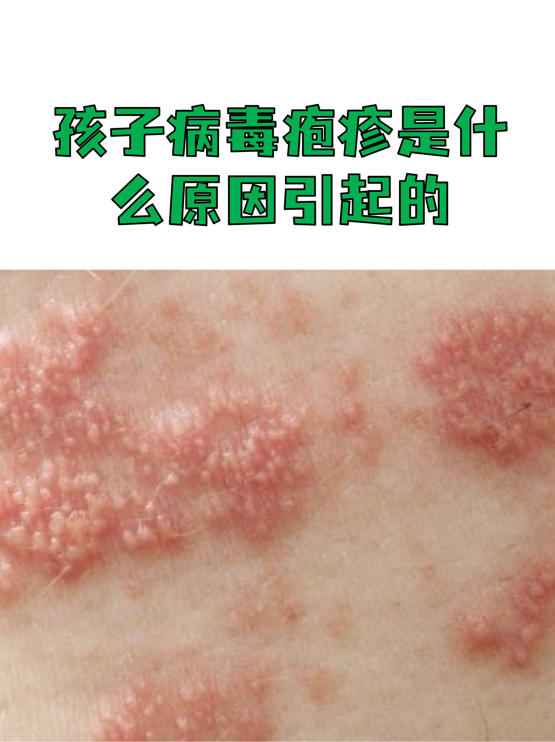  最近小孩流行的病毒叫什么(最近小孩流行的病毒叫什么名字)