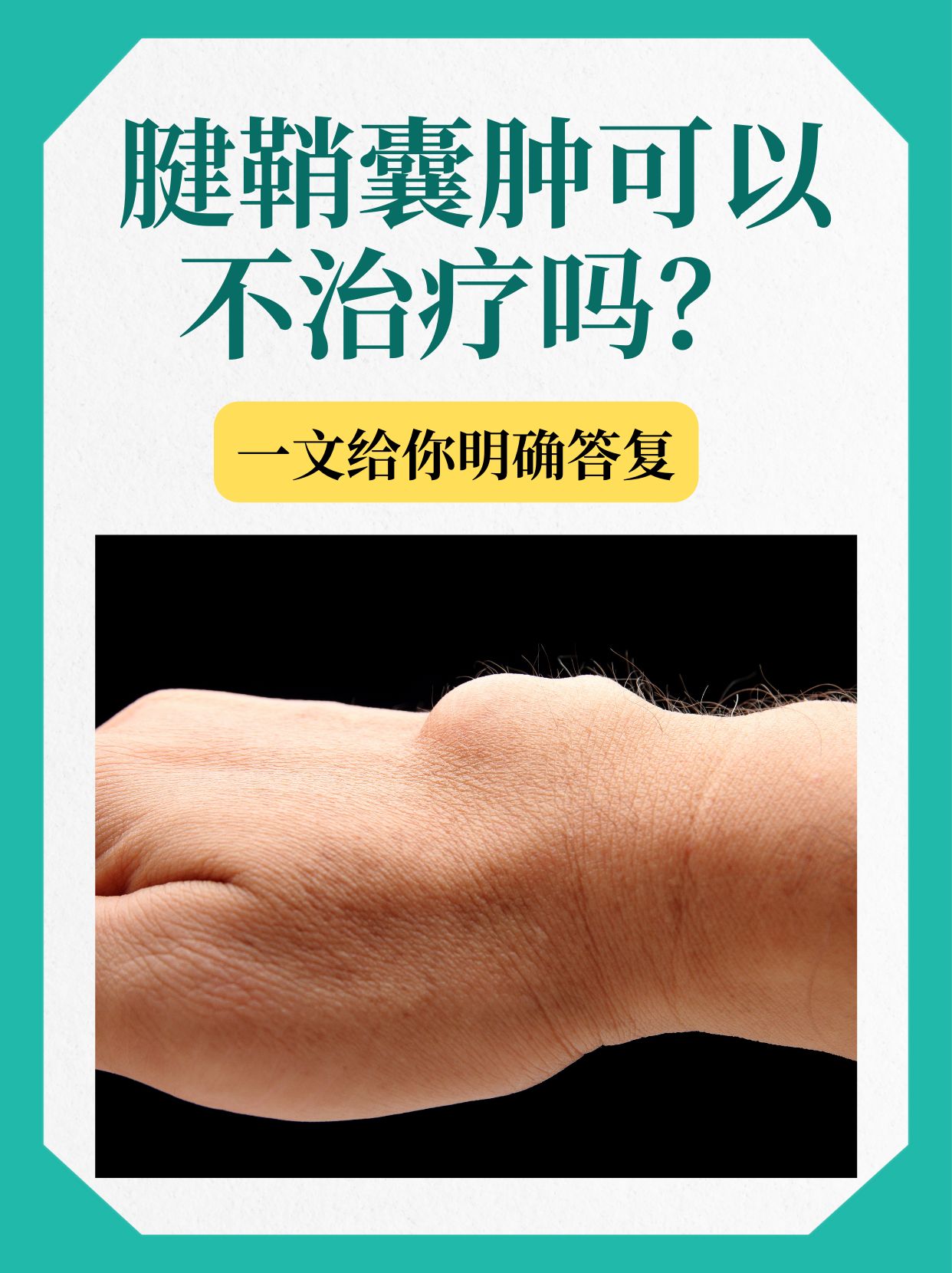 腱鞘囊肿可能是临近组织退变