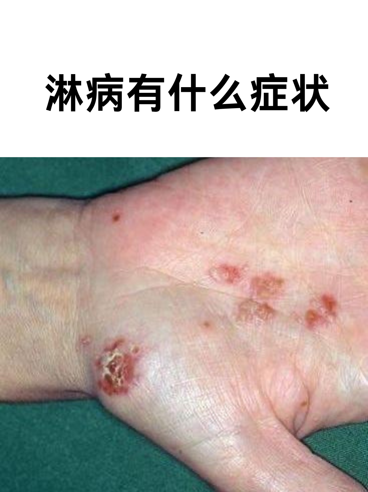 淋病是由淋病奈瑟球菌引起的性传播疾病,早期症状常