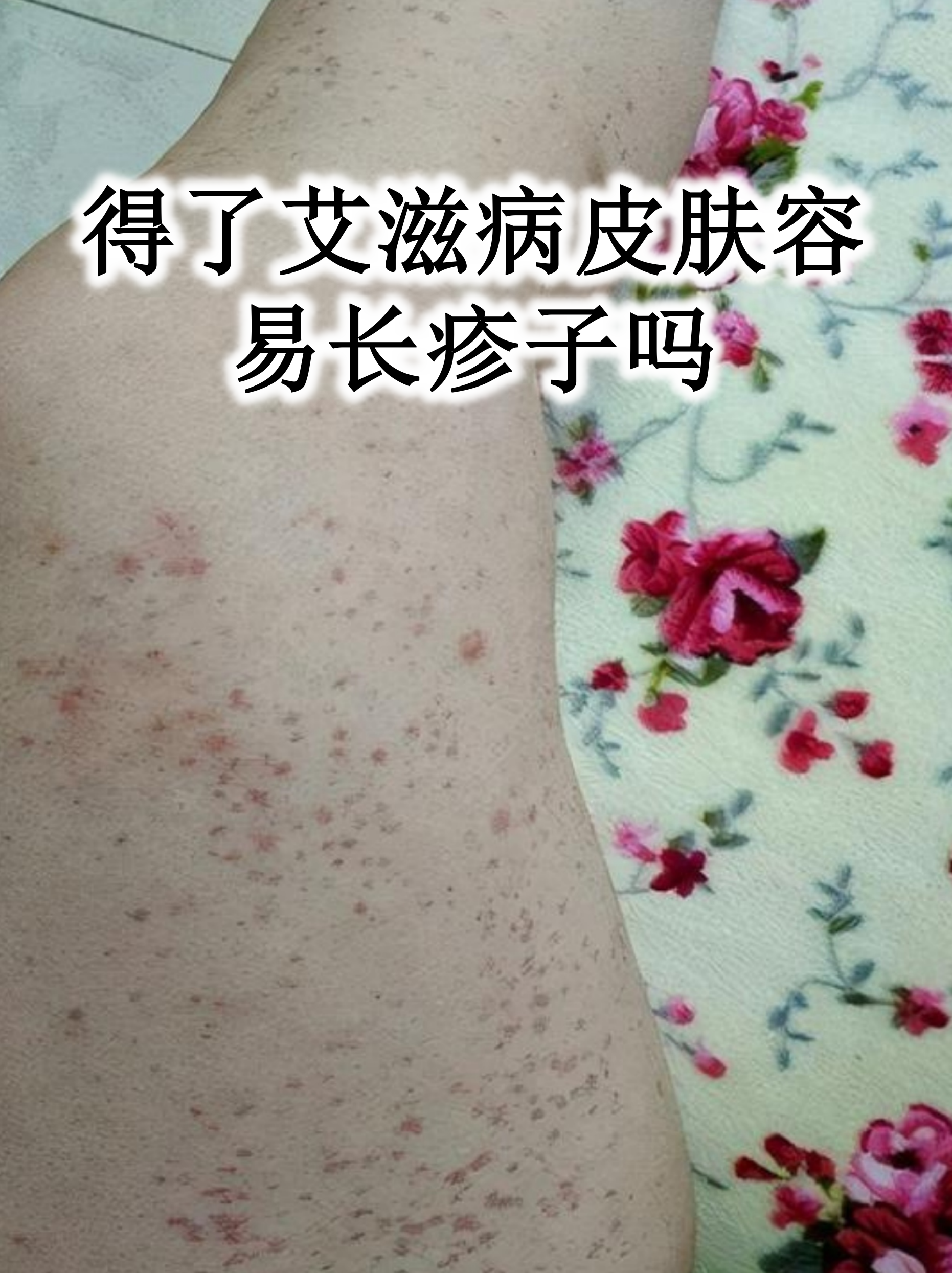 得了艾滋病皮肤容易长疹子吗