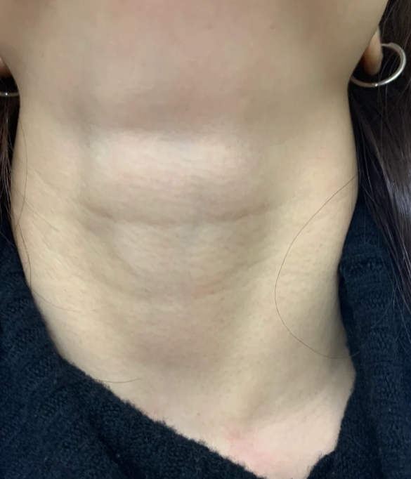 甲状腺,这个喉结下方形似蝴蝶的重要腺体,掌管着我们全身的新陈代谢