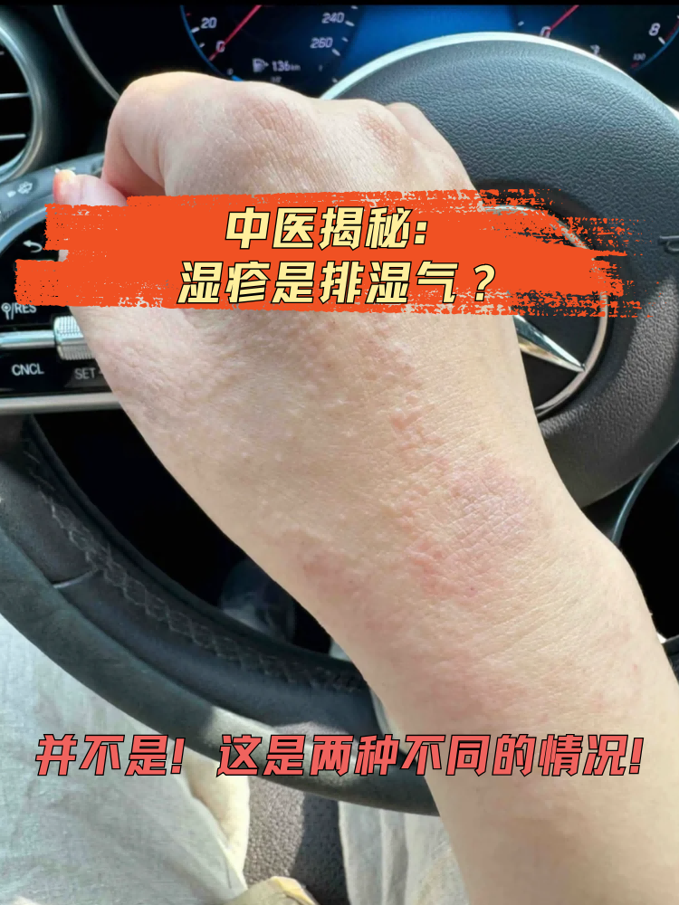 湿疹其实是一种常见的皮肤炎症性疾病,表现为皮肤发红,瘙痒,水疱