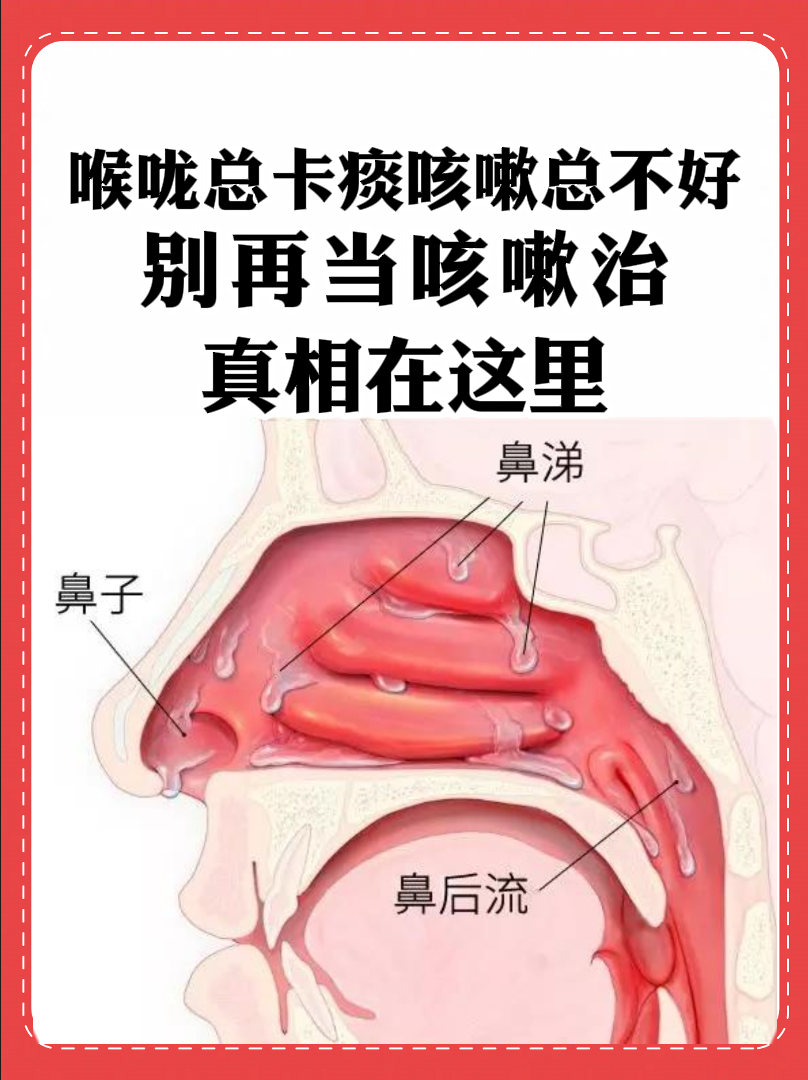 在人体精密的呼吸道系统中,鼻腔就像一座坚固的城池,而鼻粘膜则是守护
