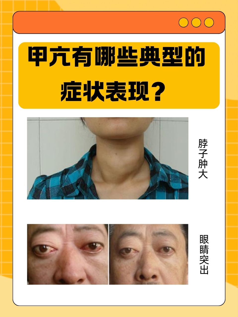 甲亢,这个由甲状腺激素分泌过多引起的疾病,不仅影响着身体的新陈