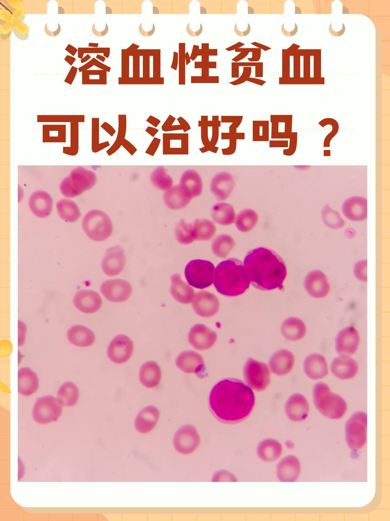 溶血性贫血,实际上是指红细胞在体内过早破裂,导致血液中红细胞数量