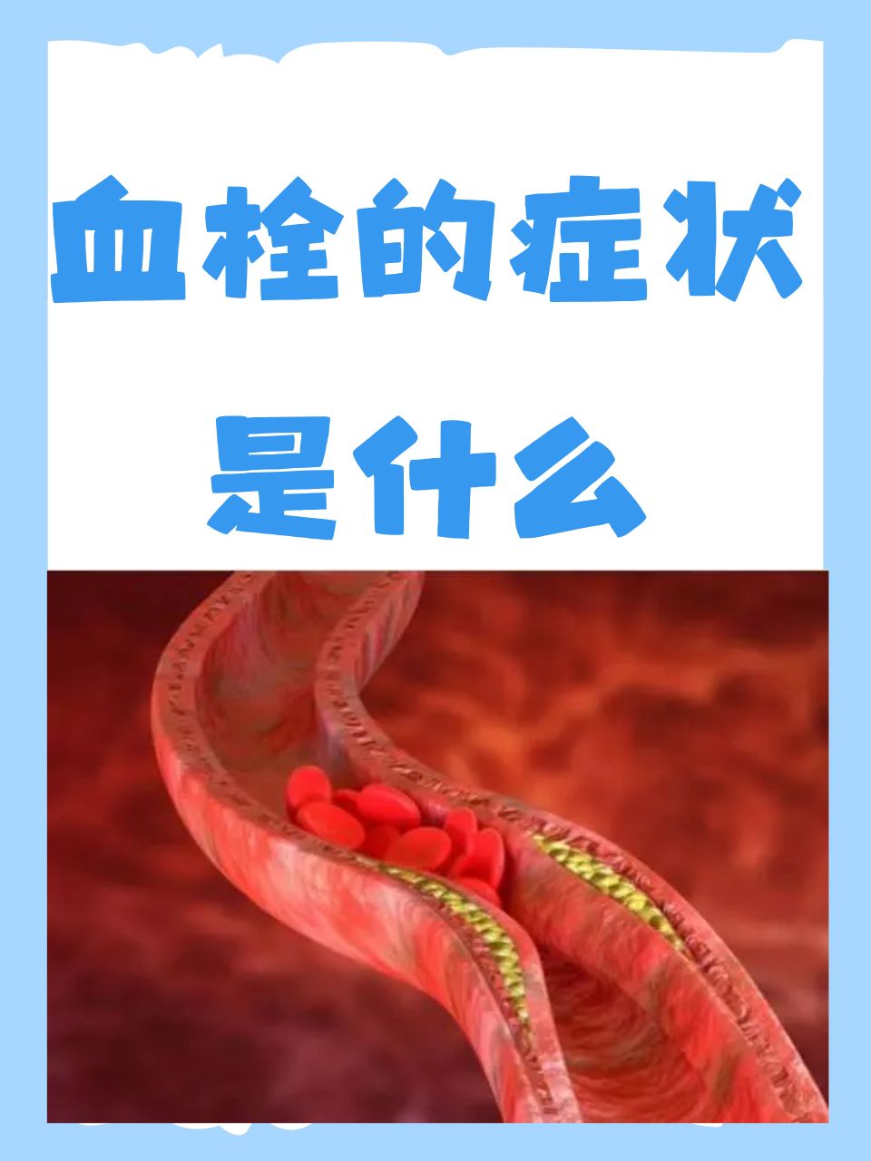 为什么会有血栓
