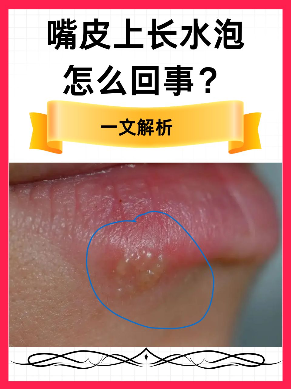 嘴皮上长水泡怎么回事?