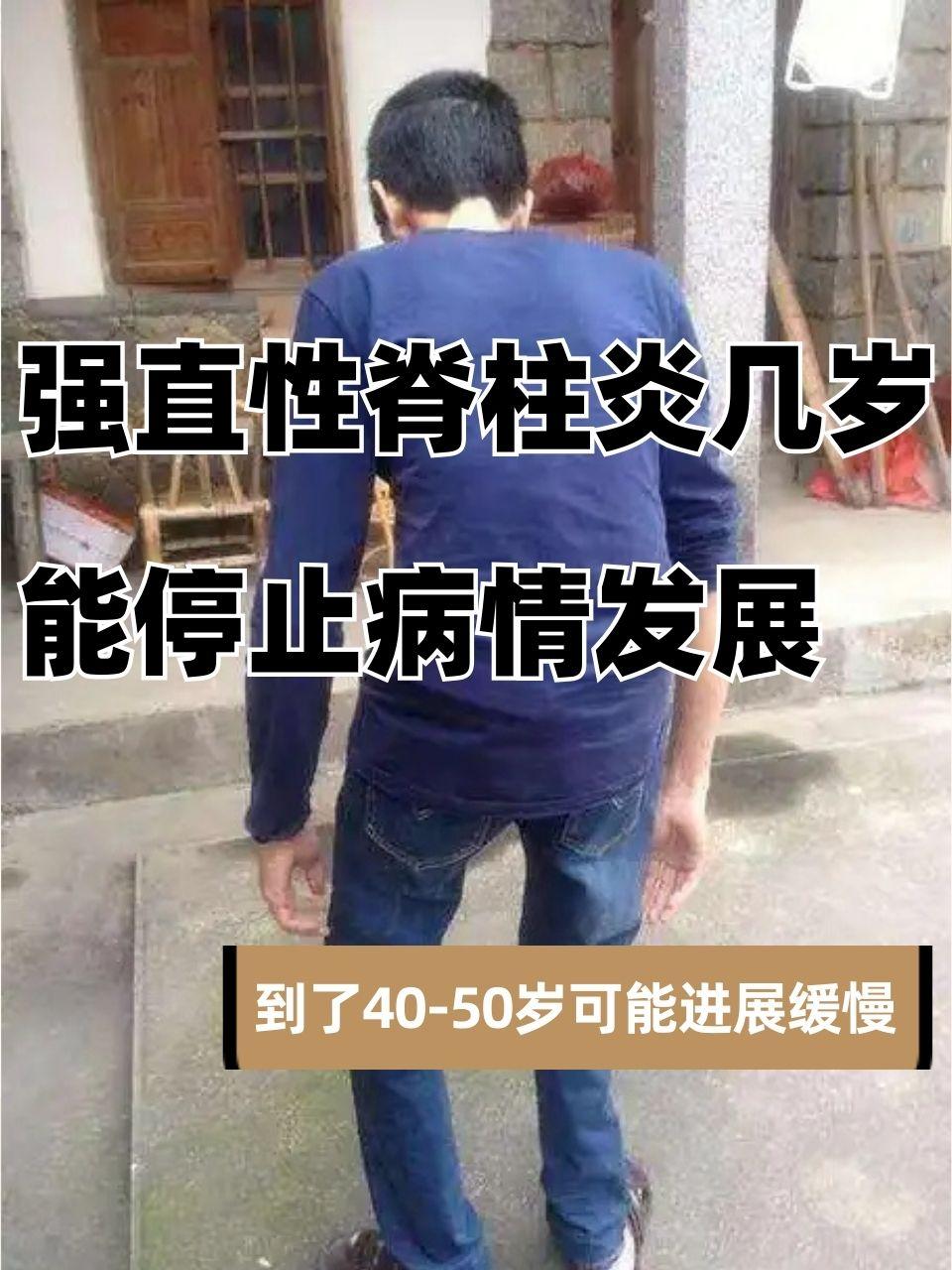 强直性脊柱炎几岁停止发展?