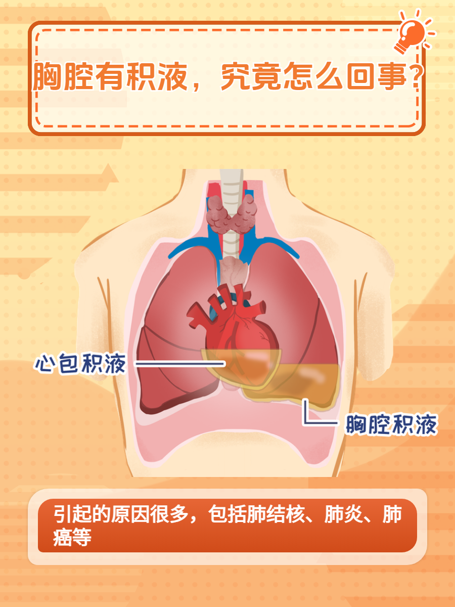 心包积液图解图片