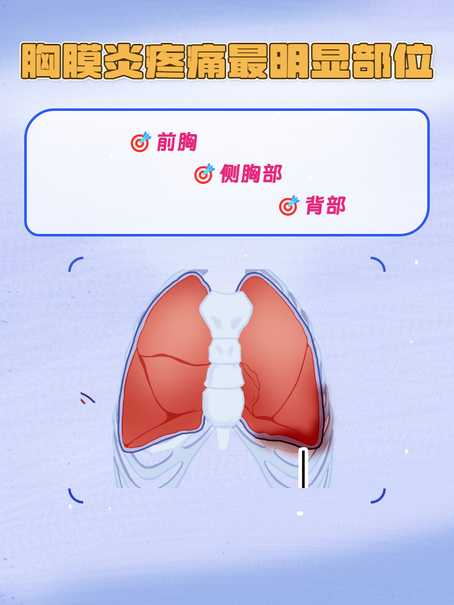 今天,我们要探讨的话题是胸膜炎