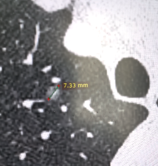 每次门诊都有朋友问我:"乔主任,我这个磨玻璃结节有没有毛刺,血管,分