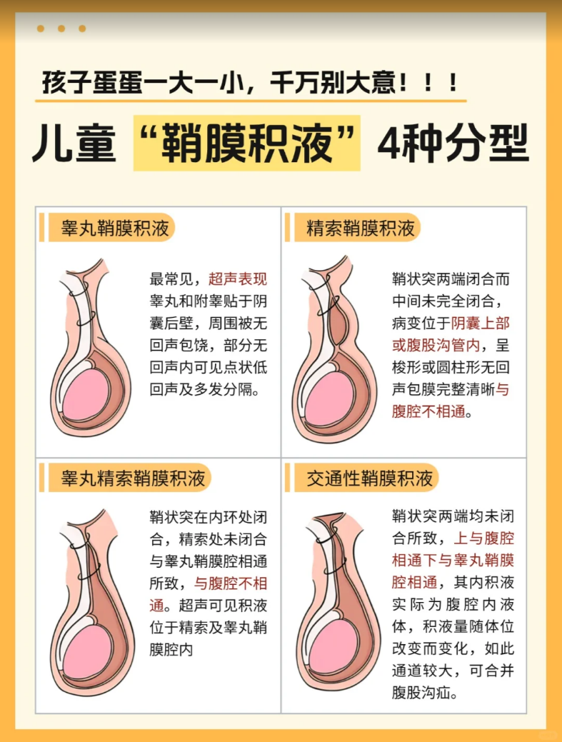 精索鞘膜积液儿童鞘膜积液鞘膜积液图片交通性鞘膜积液睾丸积液小儿