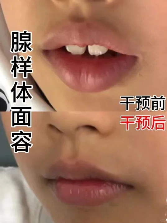 腺样体肥大有哪些特征呢?
