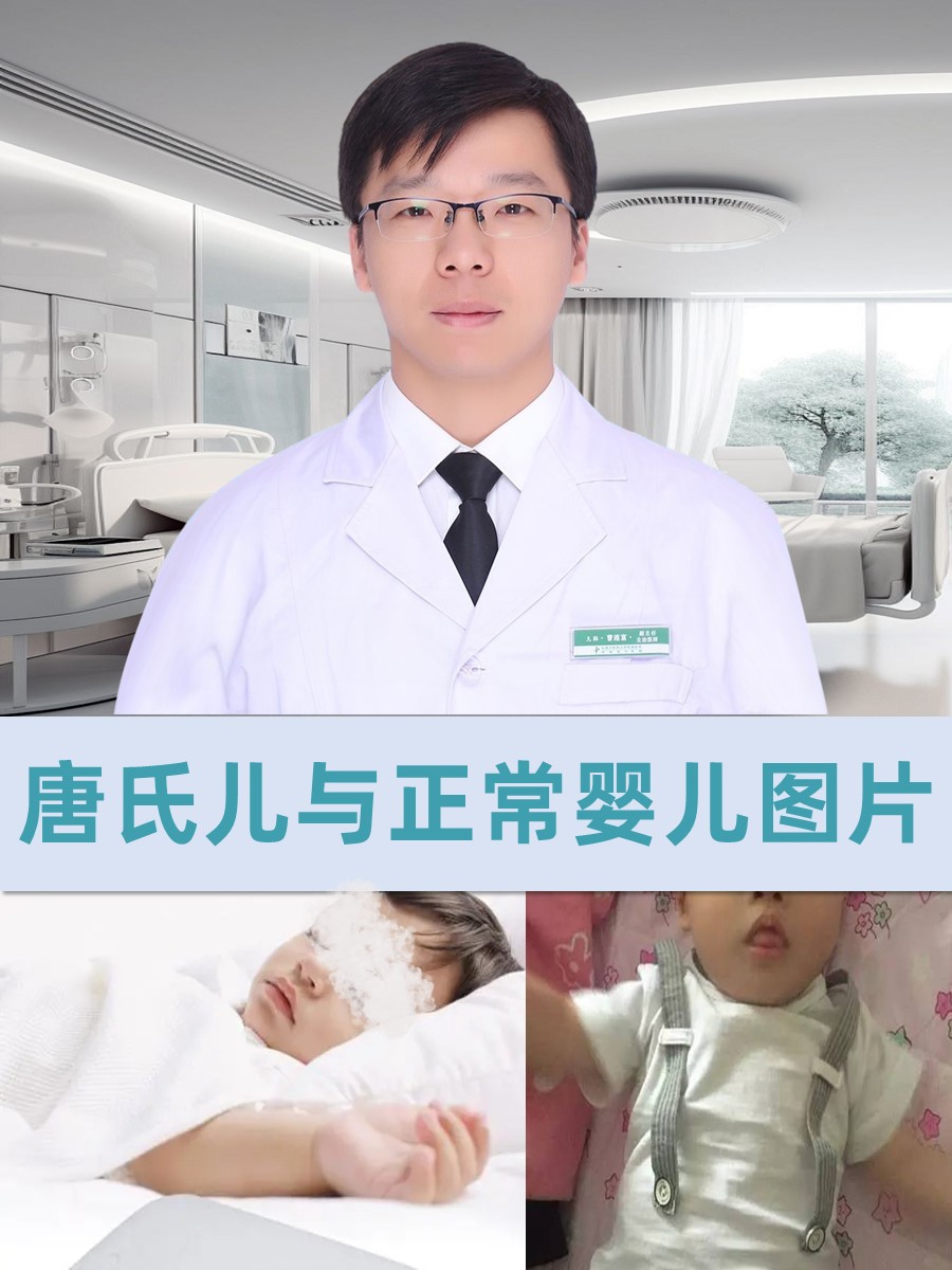 唐氏儿与正常婴儿图片