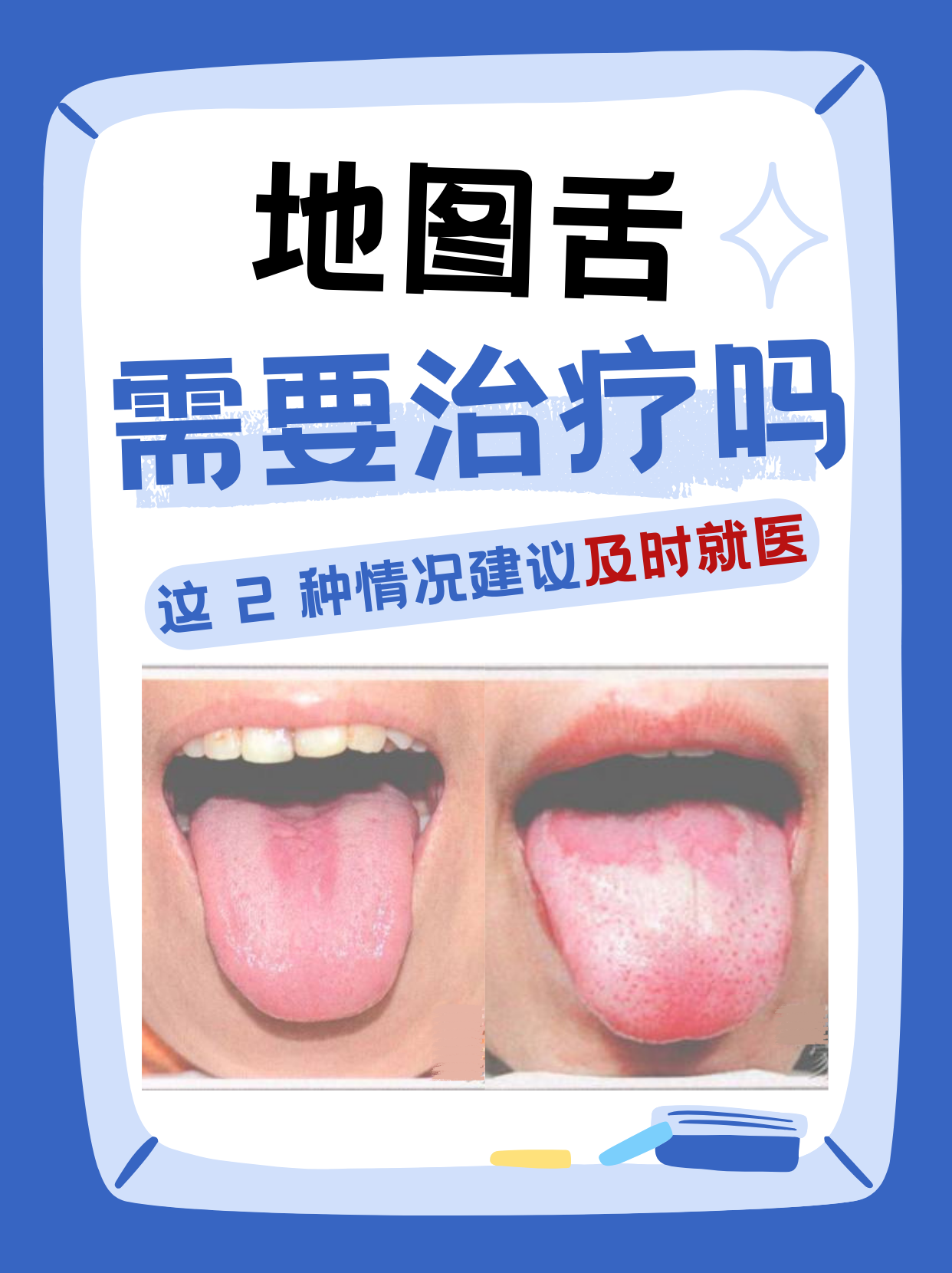 地图舌需要治疗吗?
