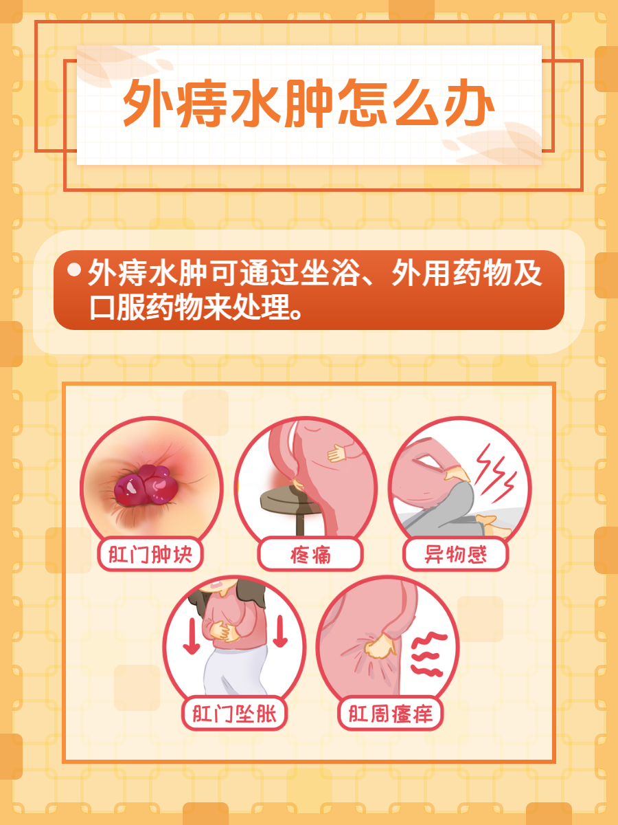 外痔水肿是痔疮的一种常见症状,给患者带来很大的不适
