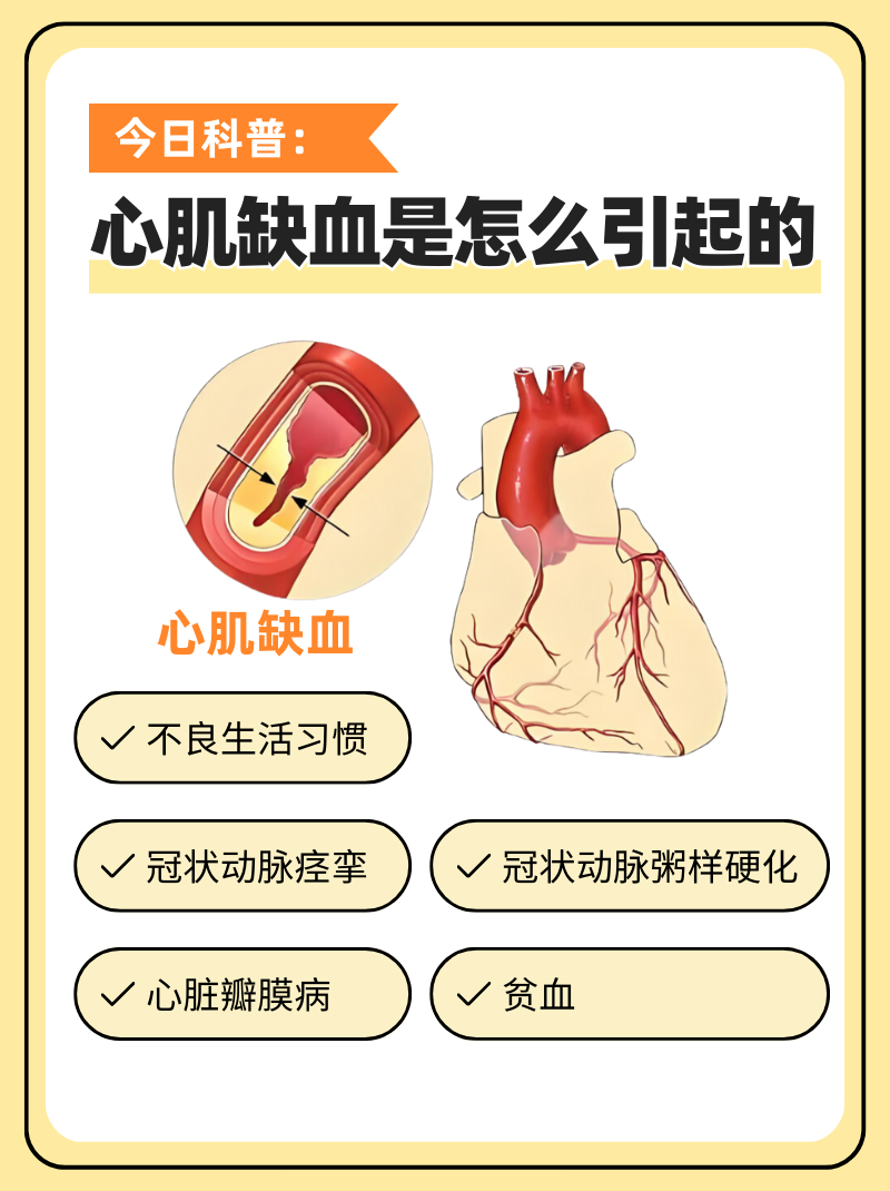 今日科普心肌缺血是怎么引起的心肌缺血是一种常见的心血管疾病,但