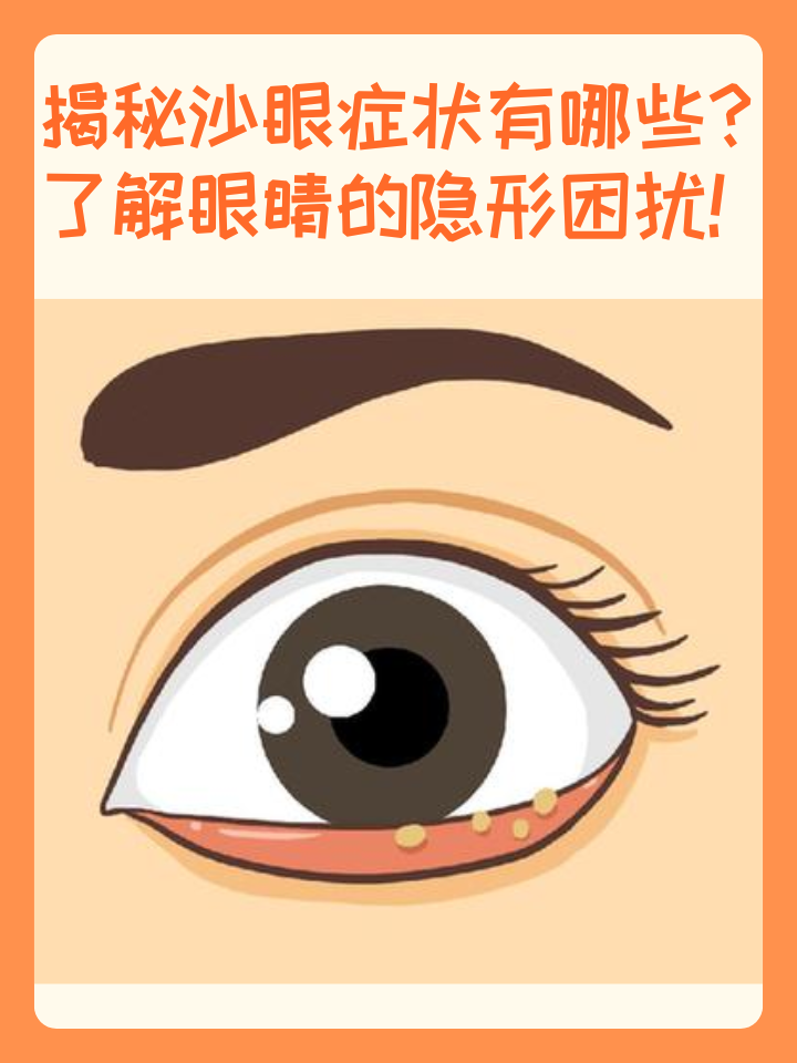 揭秘沙眼症状有哪些?了解眼睛的隐形困扰! 沙眼,又称沙眼衣原体感染,