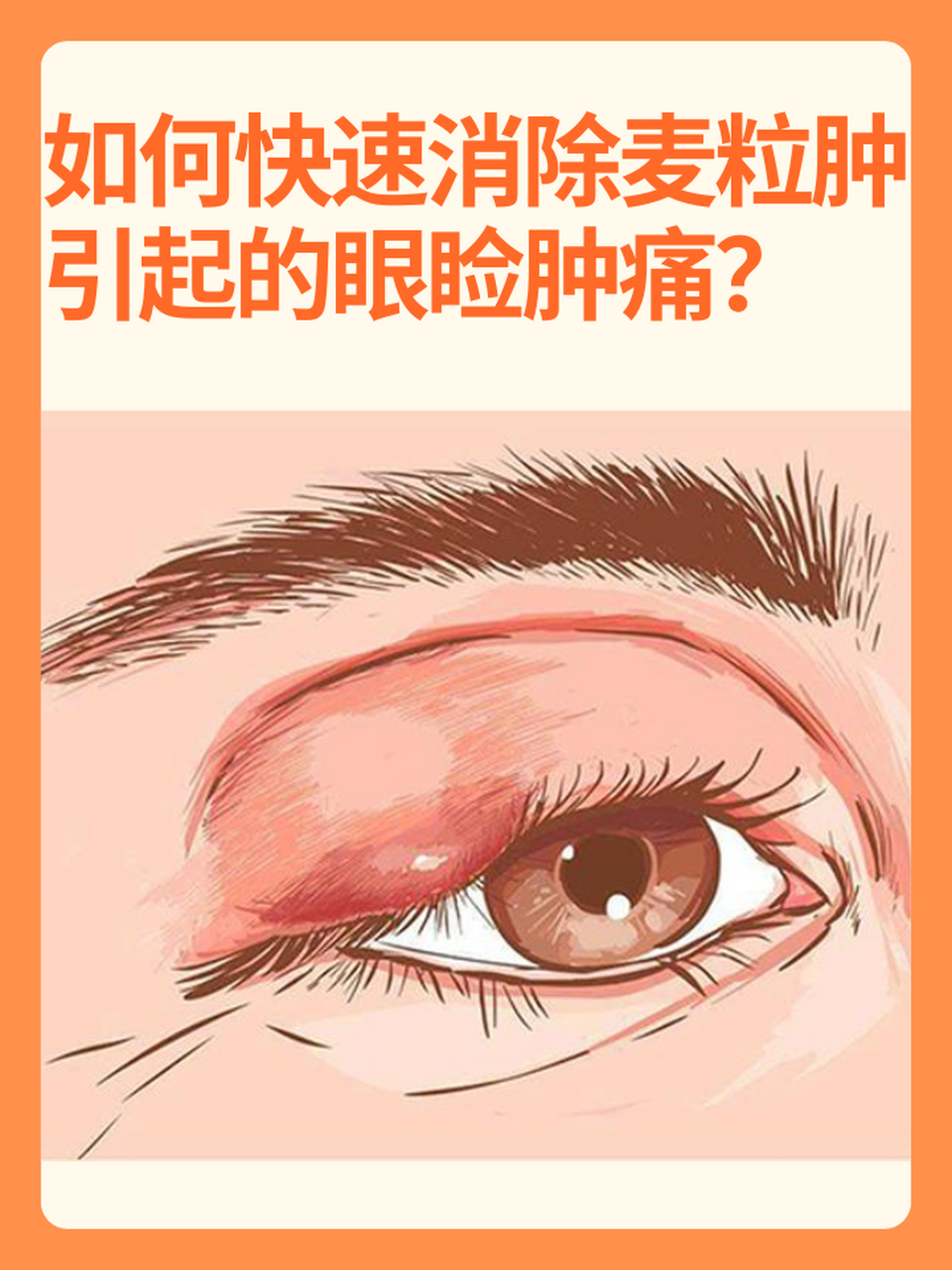 ⏩麦粒肿又称为针眼,是一种常见的眼部疾病,它的出现会导致眼睑