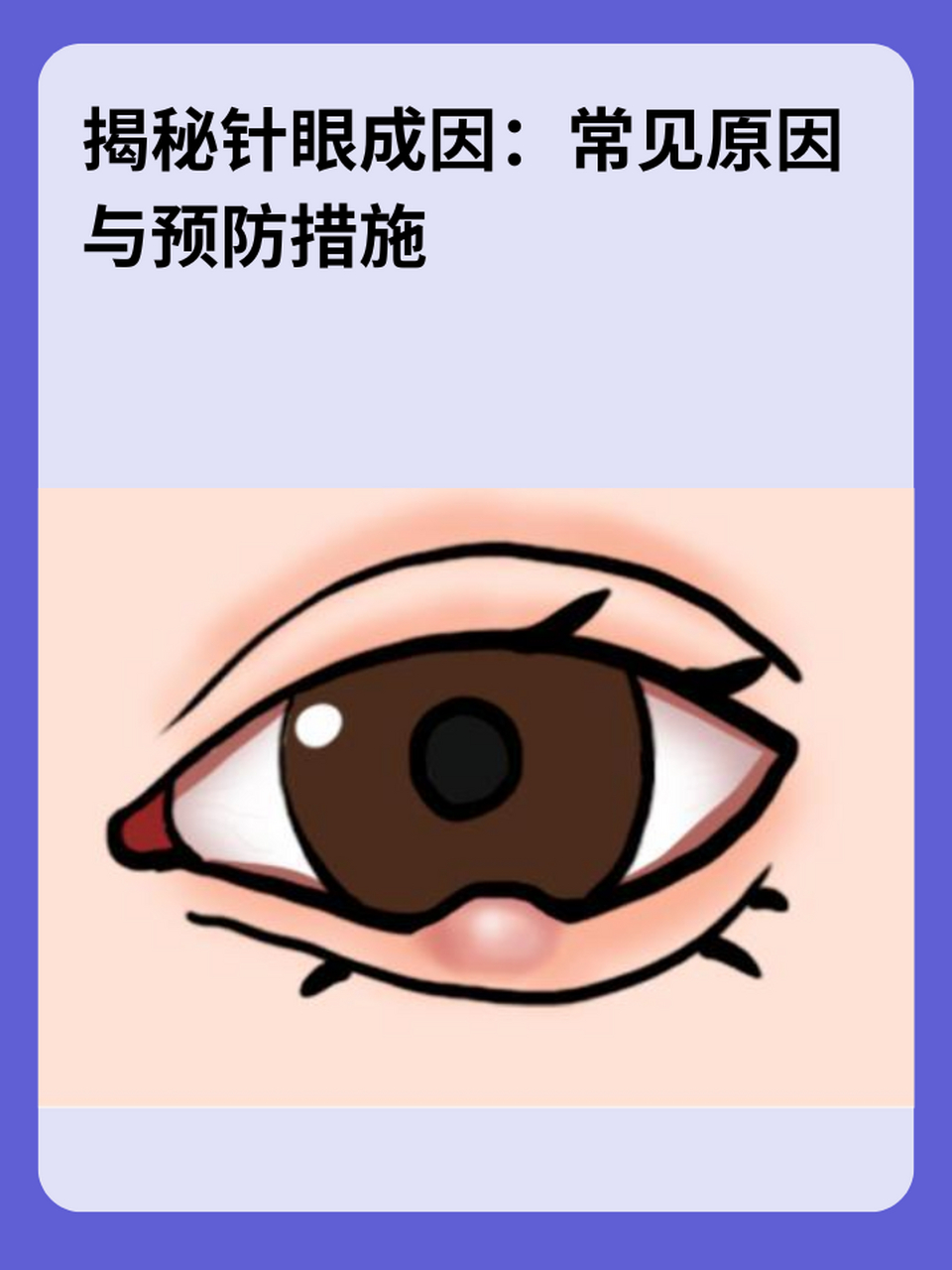 那么,究竟是什么原因导致了针眼的发生呢?