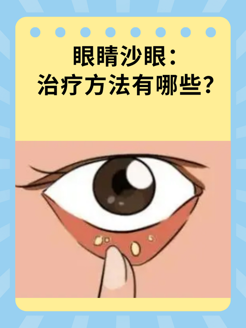 87沙眼,作为一种常见的眼部感染性疾病,不仅会给患者带来不适,还