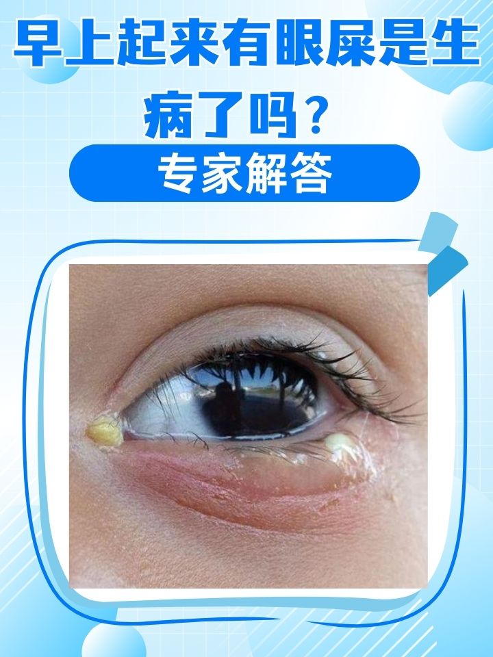 为什么早上起来眼屎多