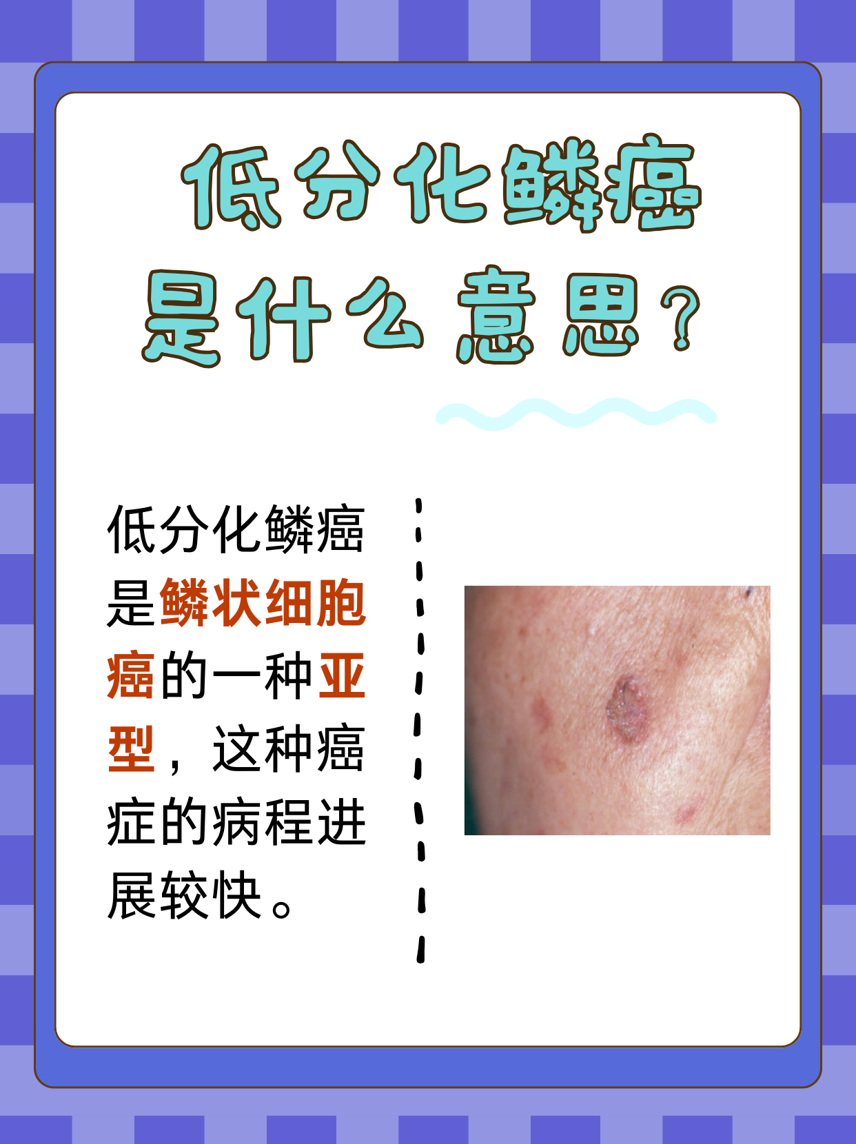 低分化鳞癌是什么意思 低分化鳞癌是一种较为严重的疾病,可以发生在