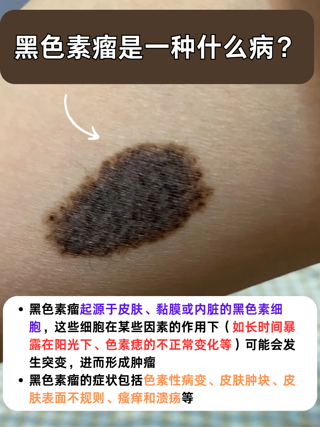 解答:黑色素瘤是一种什么病?