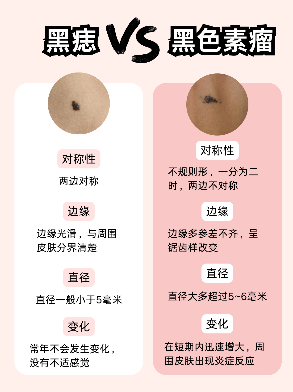 黑痣和黑色素瘤的区别 女子因为脚底涨了黑痣去就医,最后竟然被确诊了