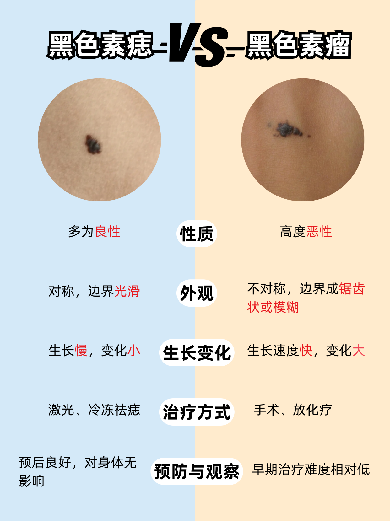 痣图片普通痣和黑色素痣区别色素瘤和色素痣的区别黑痣和黑色素瘤区别