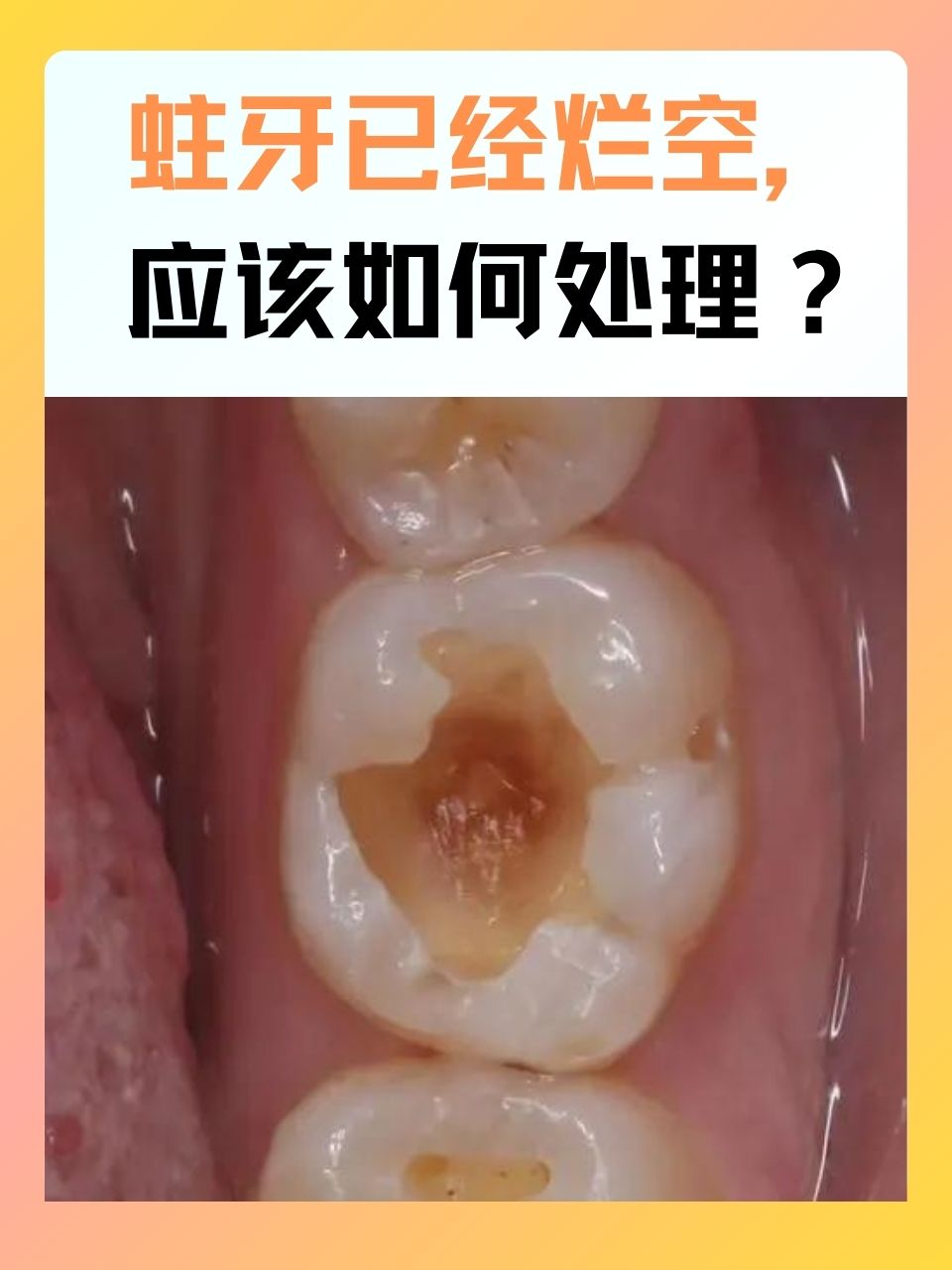 牙齿龋坏过程图片