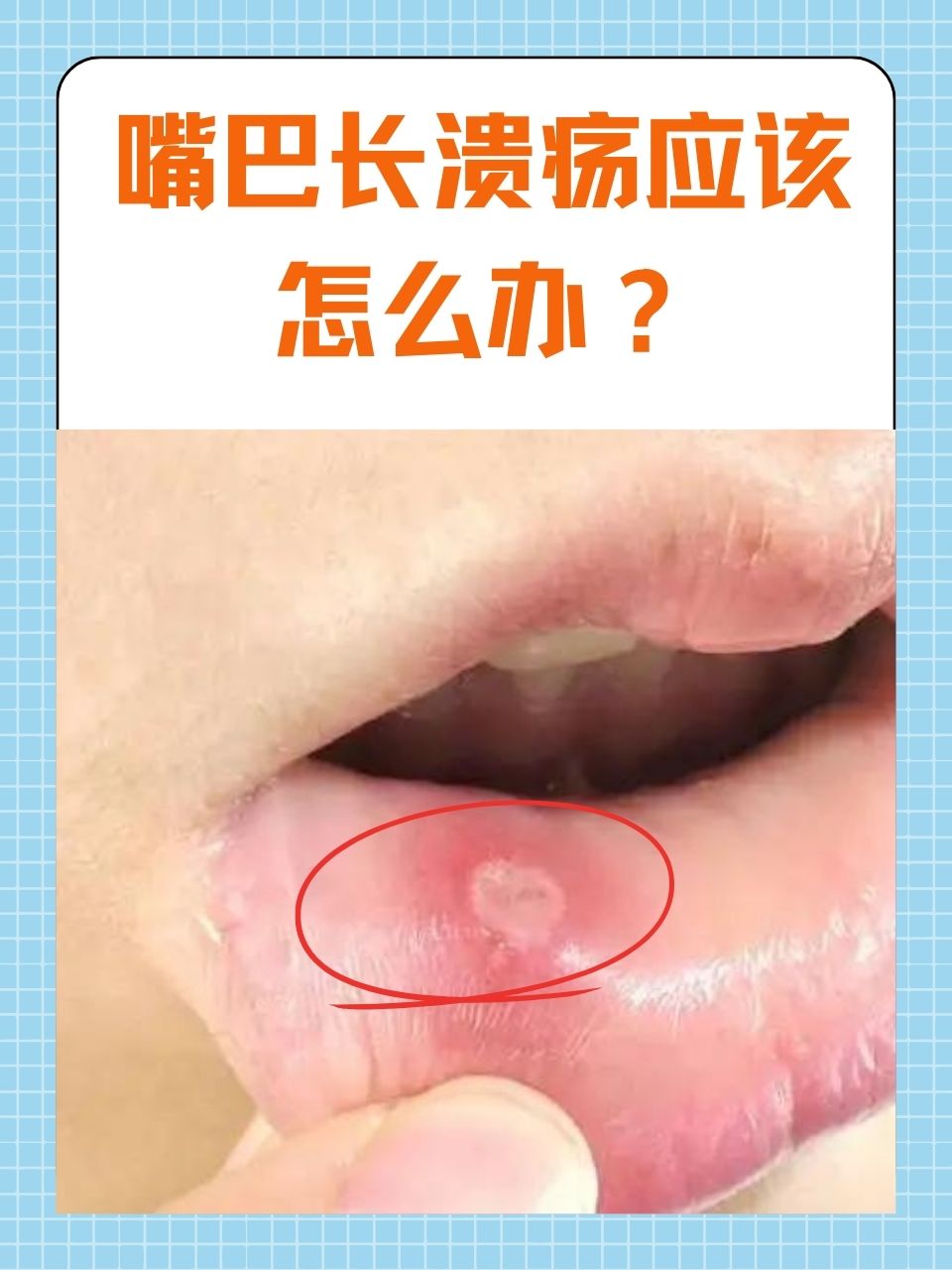 嘴巴长溃疡是一件非常痛苦的事情,它会影响我们的进食,说话,甚至会