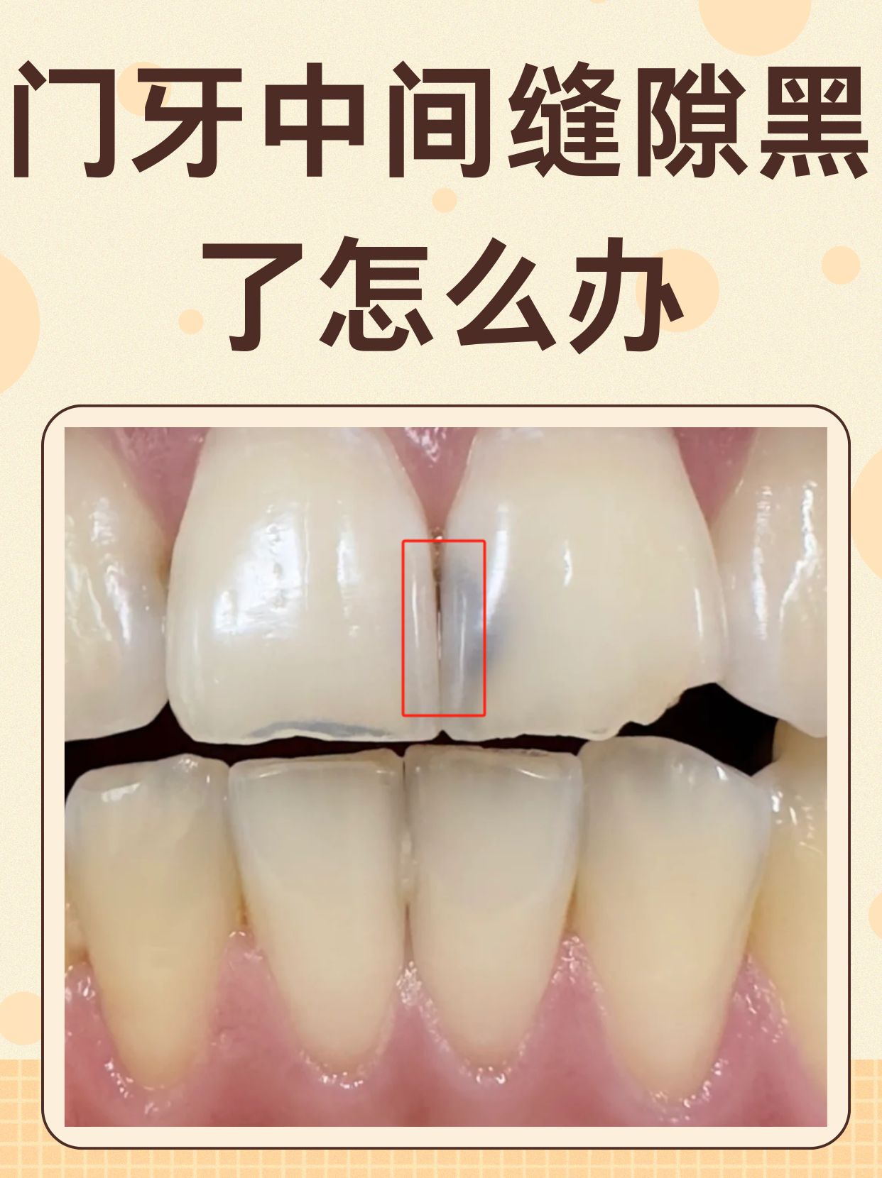 牙齿为什么会黑