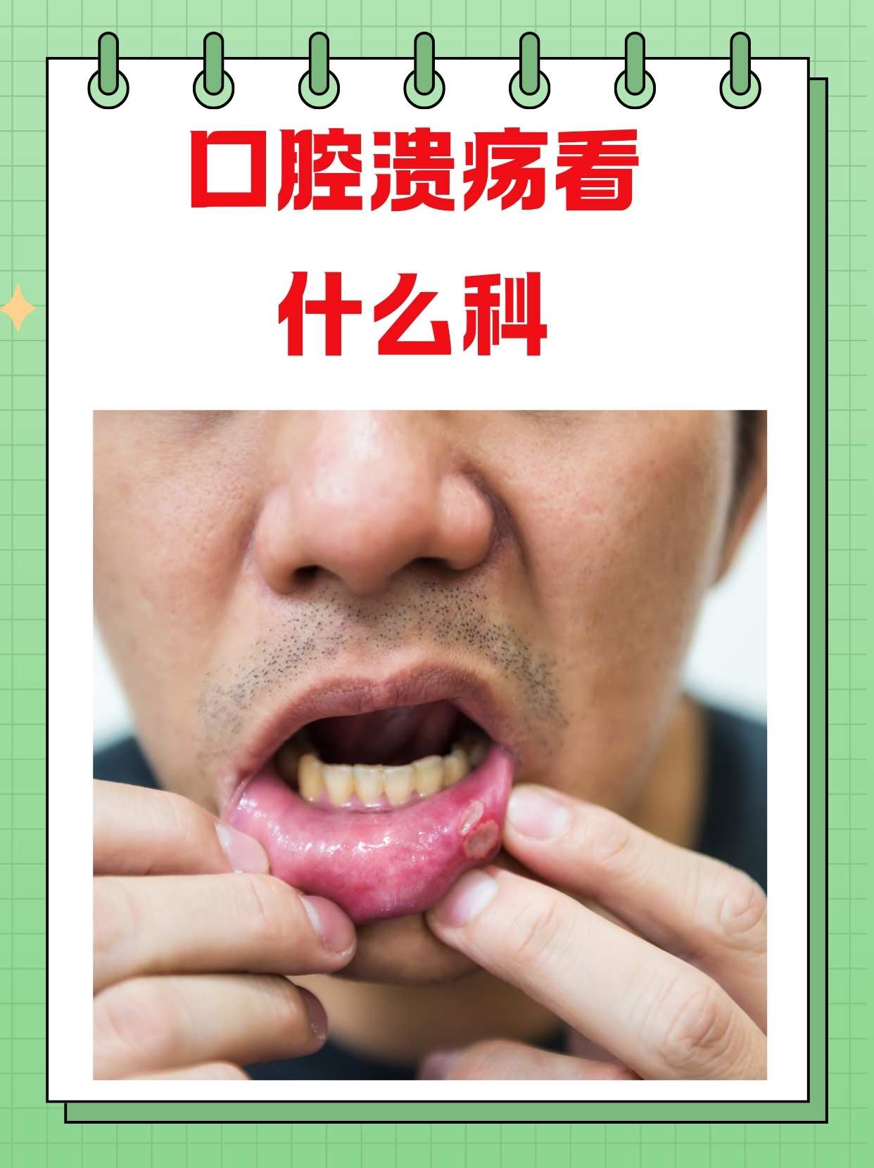 口腔溃疡自己会好吗图片